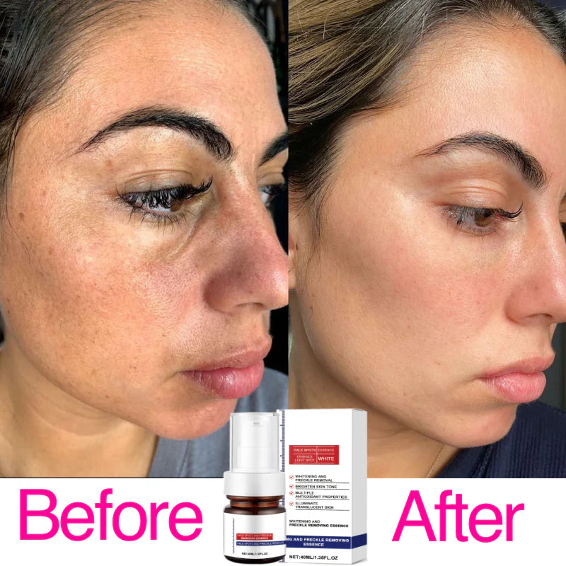 Crema facial blanqueadora de vitamina C para pecas, elimina el melasma, las manchas oscuras e ilumina la melanina