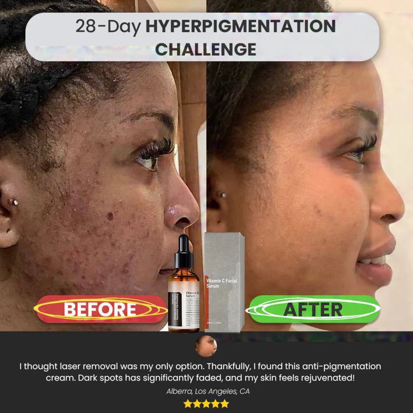 Suero con vitamina C para eliminar manchas: mejora integral de la piel – solución antienvejecimiento natural